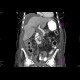 Tumour of the head of pancreas, dilated bile duct, biliary stent, dilated pancreatic duct, cholecystolithiasis, biliary stones: CT - Computed tomography